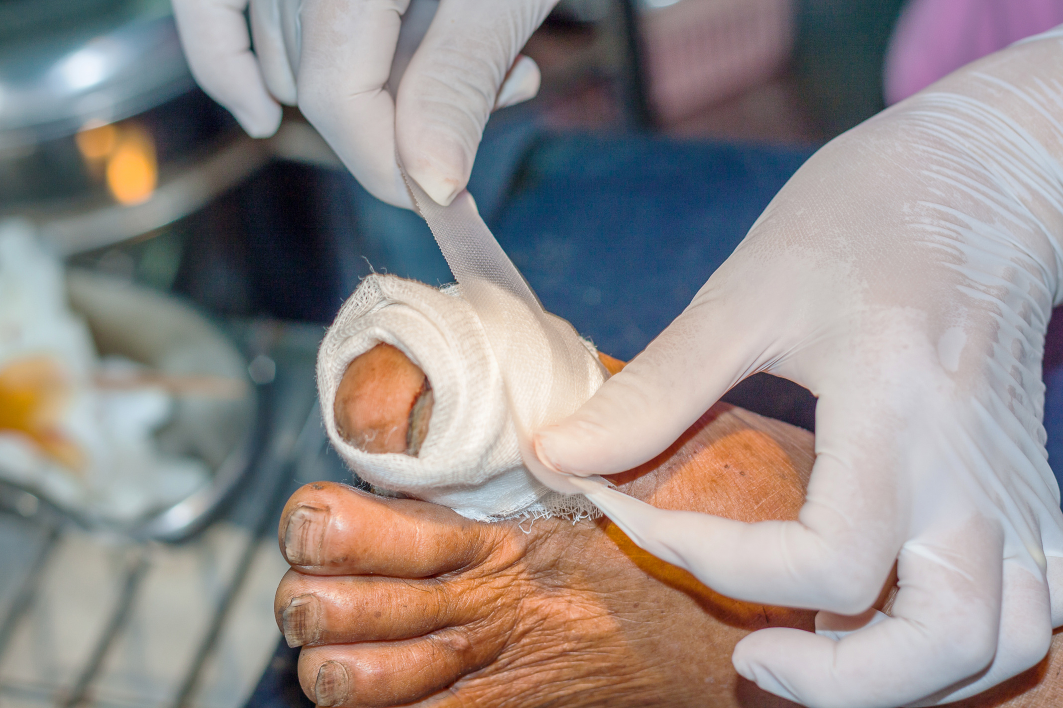 surgical wound foot